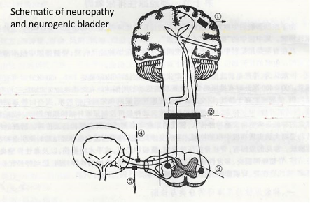 neurogenic-bladder